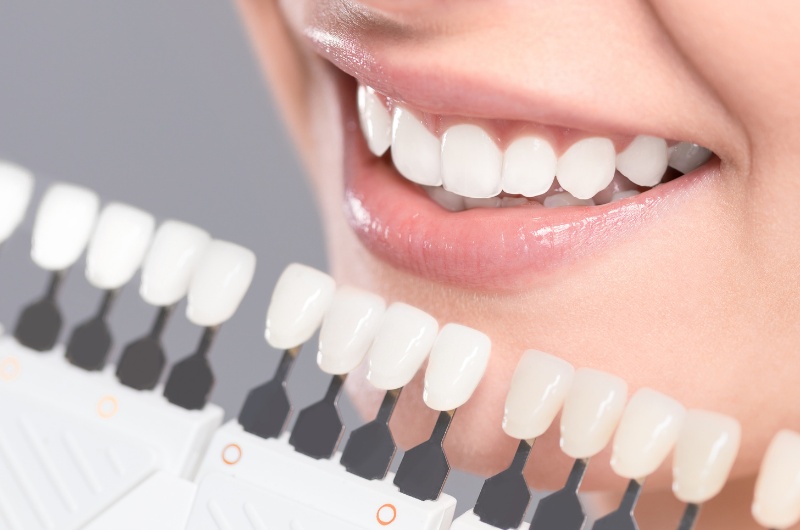 How Long Does Teeth Whitening Last?