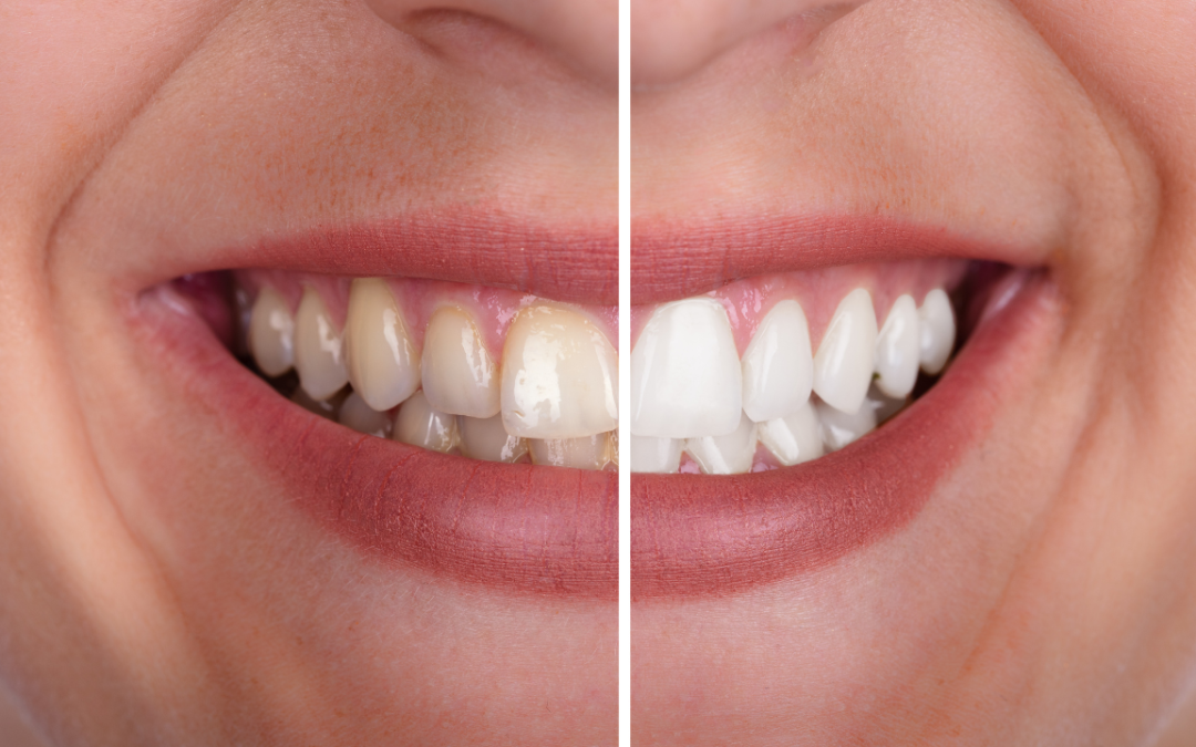 How Much Does Teeth Whitening Cost