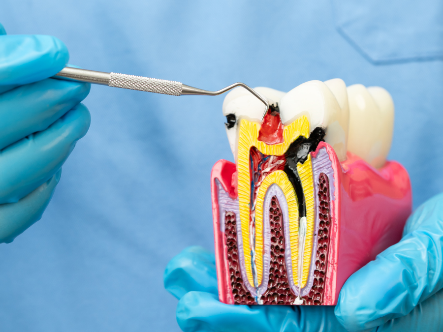 Cross-section tooth model showing infected root canal, held by a dentist in blue gloves